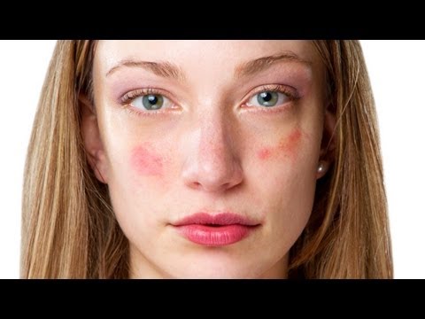 How Do Birth Control Pills Affect Acne? | Acne Treatment - 0 35 1
