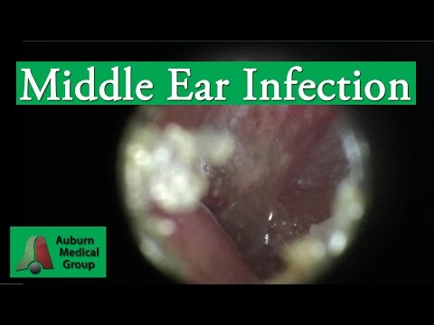 Ear Infections And Candida: Is Candida Linked To Ear Infections? - 0 83 1