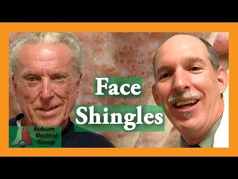 Face Shingles Treatment