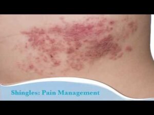 Recurring Shingles How to Battle Suddenly Activation - 0 5 1